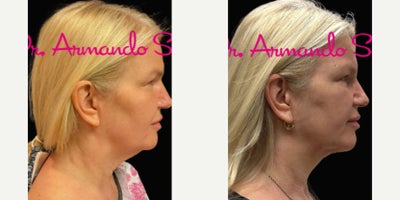 before and after image