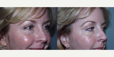 Botox before and after photo