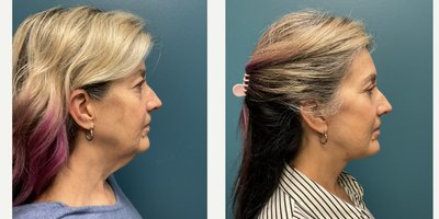 Eyelid Surgery before and after photo