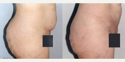 Liposuction before and after photo