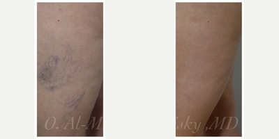Sclerotherapy before and after photo