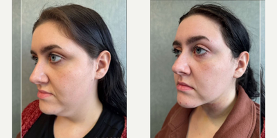Chin Liposuction before and after photo