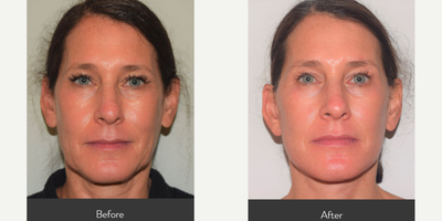Facelift before and after photo