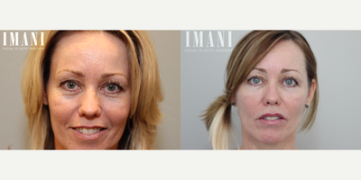 Lip Fillers before and after photo