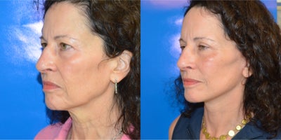 Neck Lift before and after photo