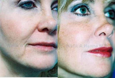 Restylane before and after photo