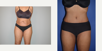 Tummy Tuck before and after photo