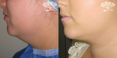 Vaser Liposuction before and after photo