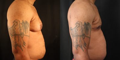 Breast Reduction before and after photo
