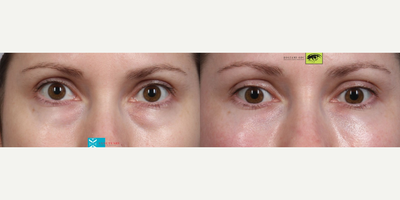 Dermal Fillers before and after photo
