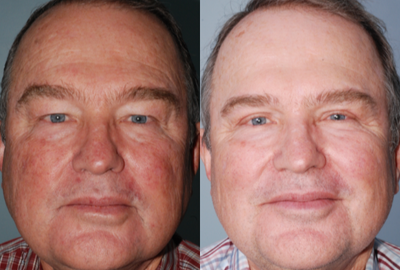Laser Resurfacing before and after photo