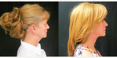 Neck Lift before and after photo