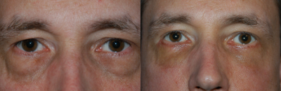 Eyelid Surgery before and after photo