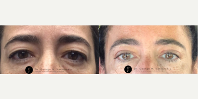 Eyelid Surgery before and after photo