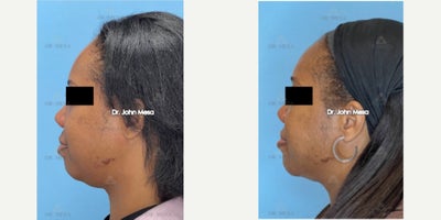 FaceTite before and after photo