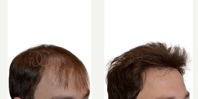 Hair Transplant before and after photo