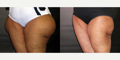 Liposuction before and after photo