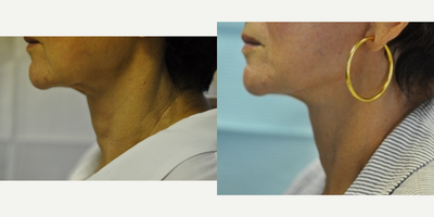 Mini Facelift before and after photo