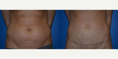 Tummy Tuck before and after photo