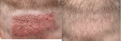 ARTAS Robotic Hair Transplant before and after photo