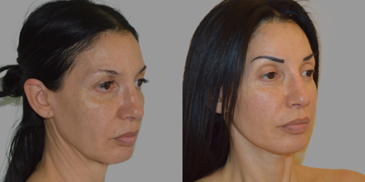 Brow Lift before and after photo
