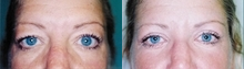 Eyelid Surgery before and after photo