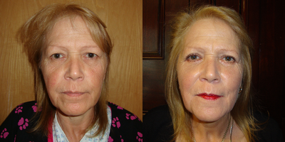 Eyelid Surgery before and after photo