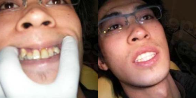Dental Bridge before and after photo