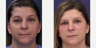 Facial Fat Transfer before and after photo