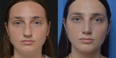 Rhinoplasty before and after photo