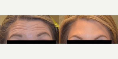 Botox before and after photo