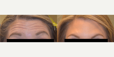 Botox before and after photo
