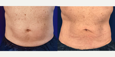 CoolSculpting before and after photo