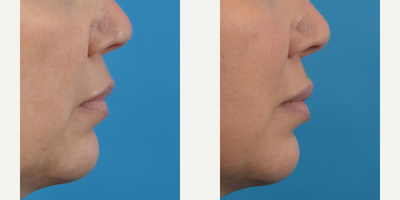 Dermal Fillers before and after photo