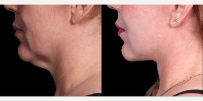 Facial Fat Transfer before and after photo