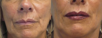 Juvederm before and after photo