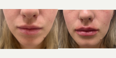 Lip Fillers before and after photo