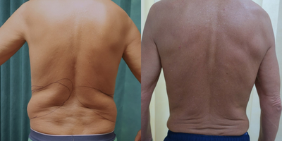 Liposuction before and after photo