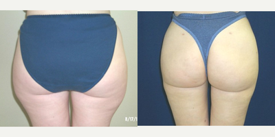 Liposuction before and after photo