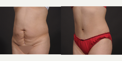 Tummy Tuck before and after photo