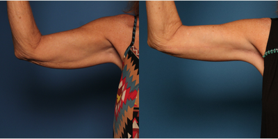 Arm Lift before and after photo