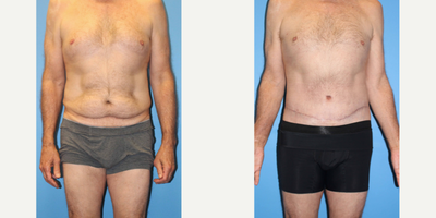 Body Lift before and after photo