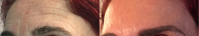 Dysport before and after photo