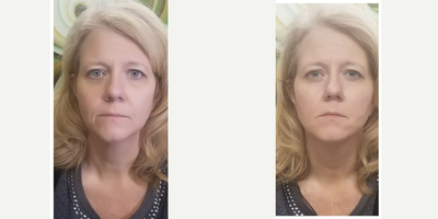 Nonsurgical Facelift before and after photo