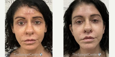 Deep Plane Facelift before and after photo