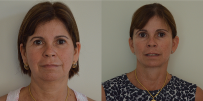 Facelift before and after photo