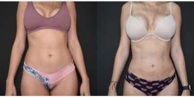 Liposuction before and after photo
