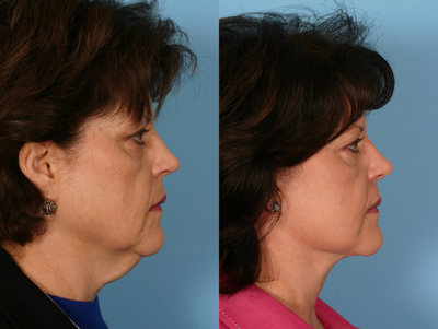 Lower Facelift before and after photo