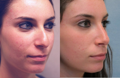 Rhinoplasty before and after photo