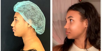 Rhinoplasty before and after photo